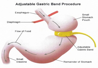 gastric1
