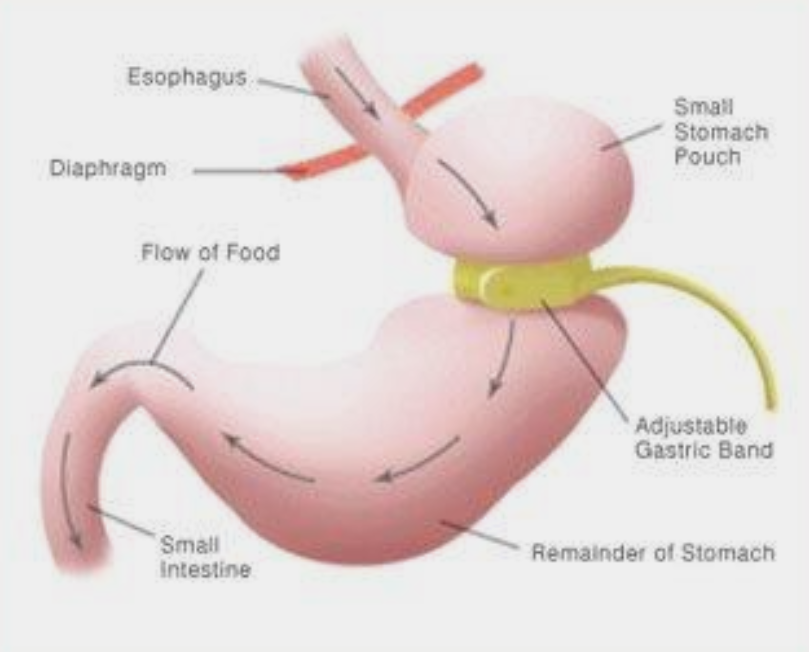 Virtual gastric band